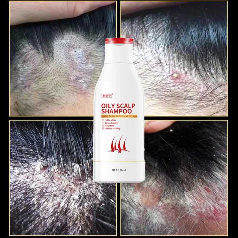 Scalp Cleansing Psoriasis Shampoo Anti-itching Oil Control Folliculitis Dandruff Seborrheic Antibacterial Mites Removal Acne