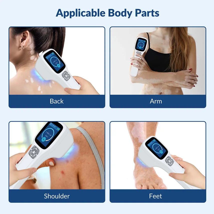 ZJKC 308nm Экксимерная система Фотодинамическая терапия УФ-световое устройство для