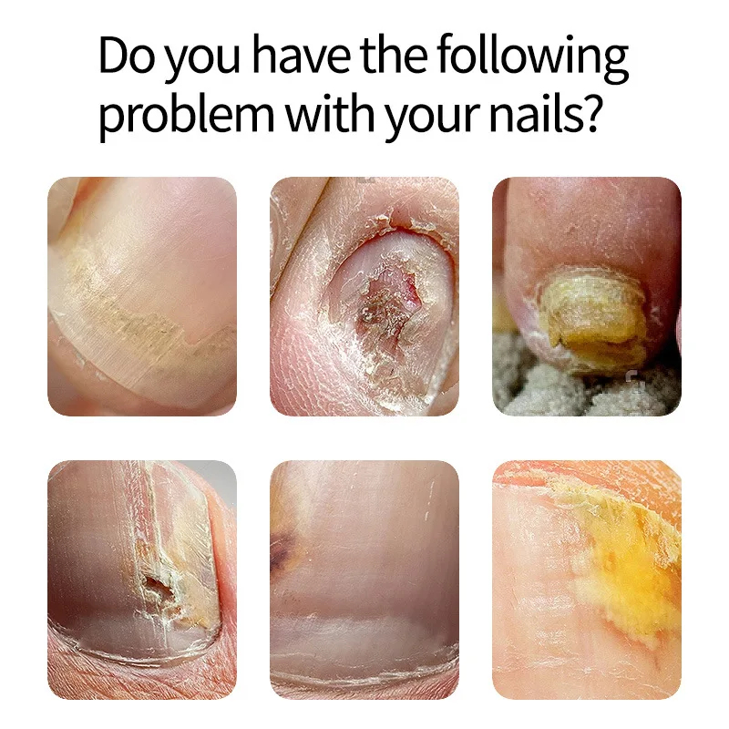 Nail Repair Remove Onychomycosis Liquid Nail Treatment Essence Fungus Toe Nourishing Brighten Nail Onychomycos Foot Feet Care