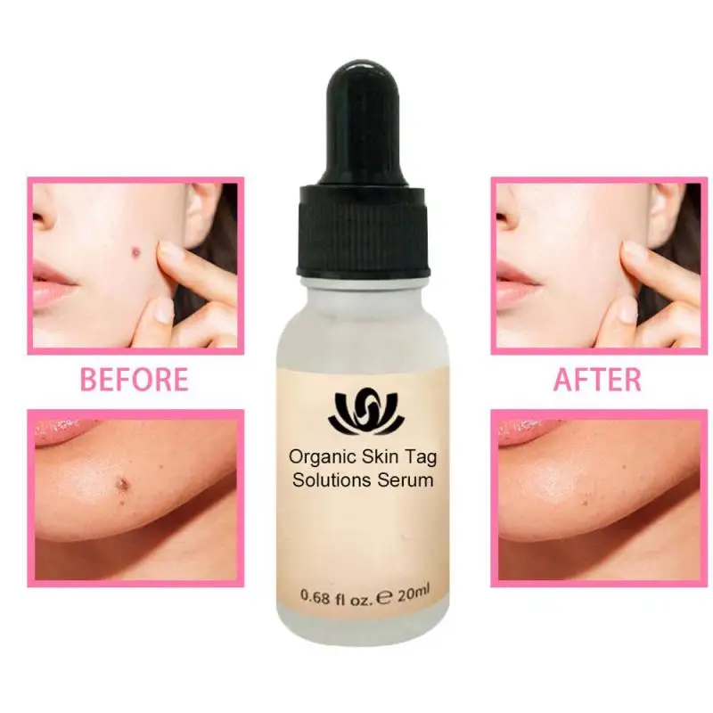 

Organic Tags Solutions Serum Skin Painless Mole Dark Spot Remover Serum Freckle Face Wart Tag Removal Cream Oil Plaster 20ml