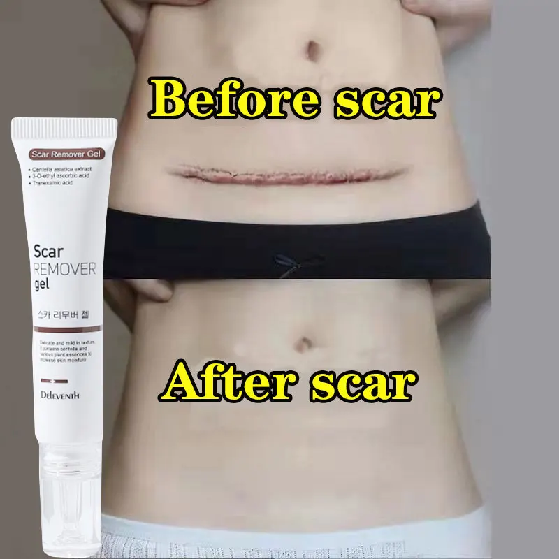 

Acne Scar Removal Cream Repair Maternity Stretch Marks Gel Remove Burn Scars Surgical Treatment Smooth Damaged Body Skin Care