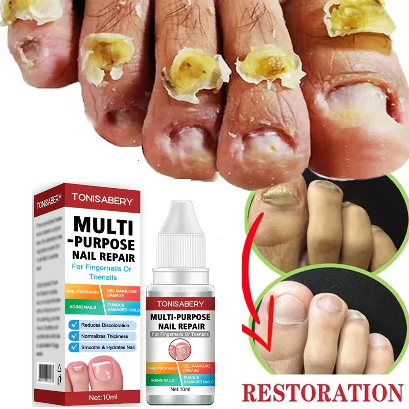

Nail Fungal Treatment Essence Anti Infection Feet Cuticle Remove Care Serum Paronychia Onychomycosis Toe Nail Fungus Repair10ml