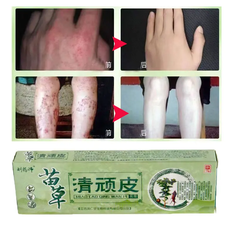 

Psoriasis Cream For Dermatitis And Eczema Secret DermatiTis Skin Repair Cream Onychomycosis Paronychia Skin Care Cream
