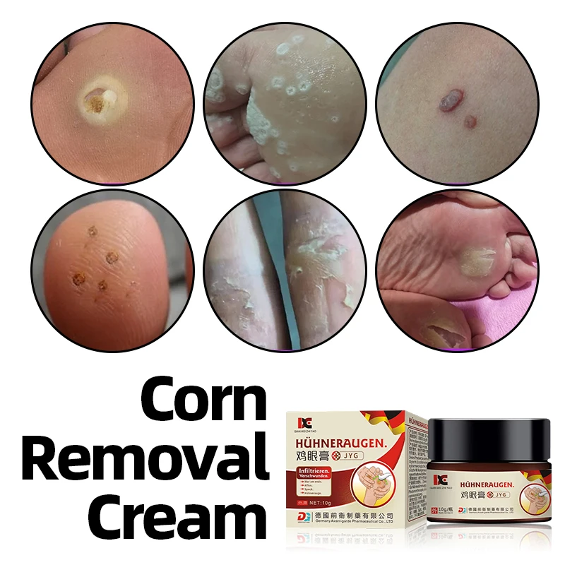 

Corn Removal Cream Foot Corns Treatment Wart Calluses Callosity Plantar Warts Remover Feet Care German Secret Recipe Medicine