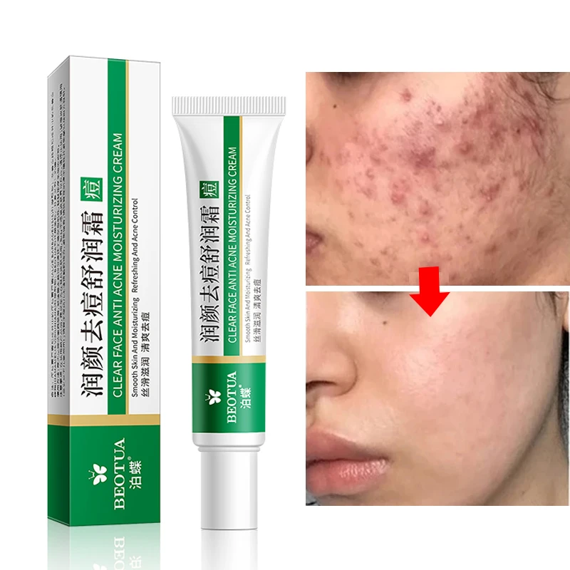 

Aloe Vera Essence Acne Removal Cream Treatment Acne Spots Oil Control Shrink Pores Cleansing Moisturizing Acne Face Care Cream