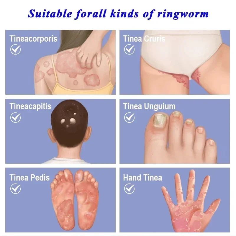 Формула Псориаз s Rash Eczema Tinea Cruris Dermatitis Papules Охлаждающий крем Бери-бери