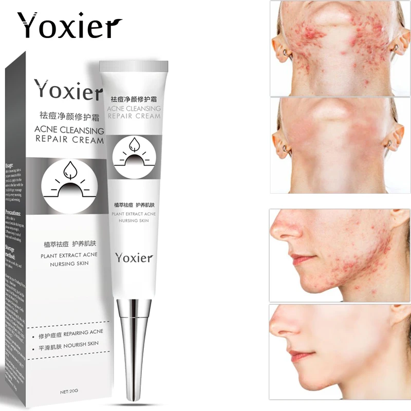 

Yoxier Acne Cream Acne Treatment Remove Blackhead Pimple Oil Control Shrink Pores Acne Scar Remove Skin Care 20g