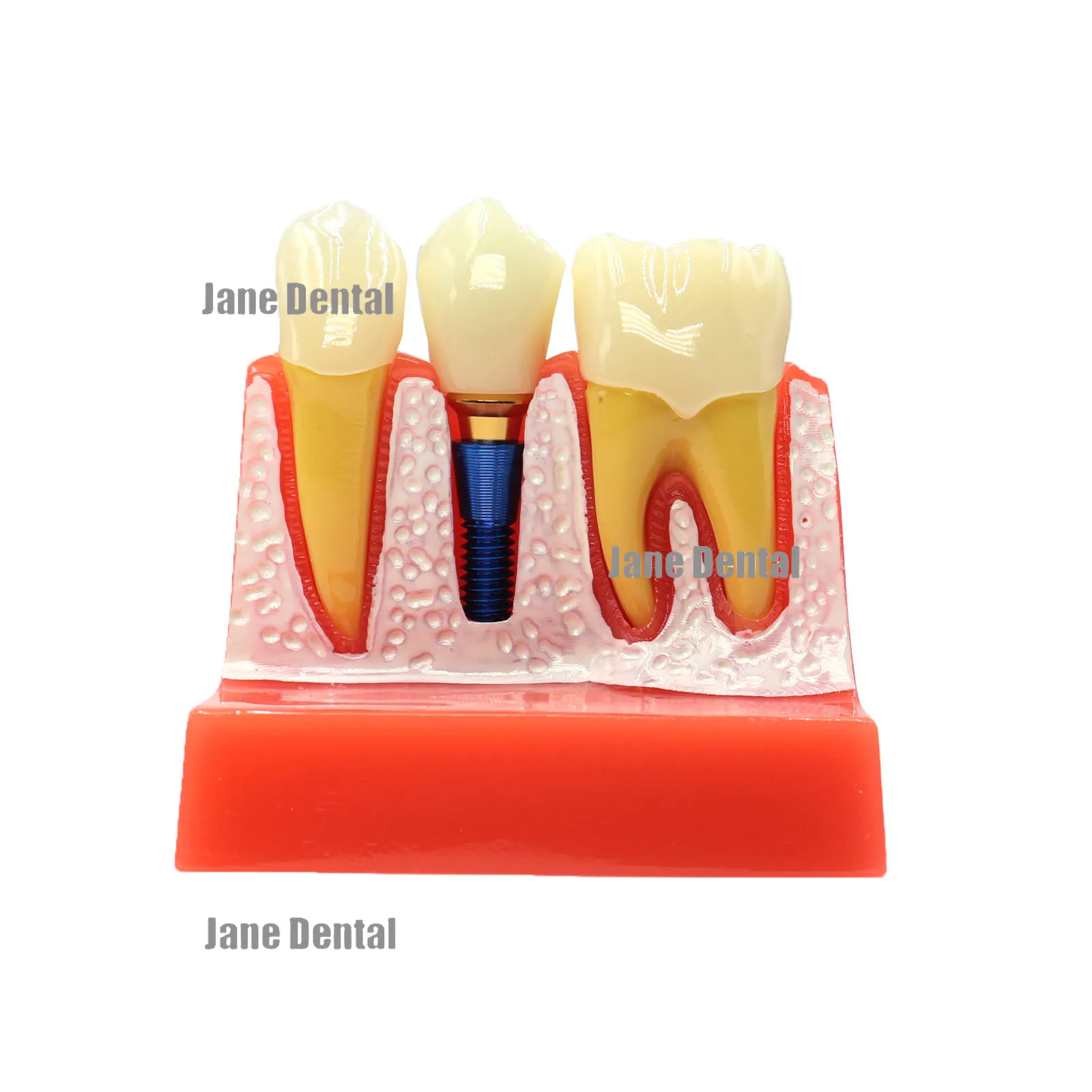

4-кратная модель зубного импланта для демонстрации дантиста, обучающая модель 2017