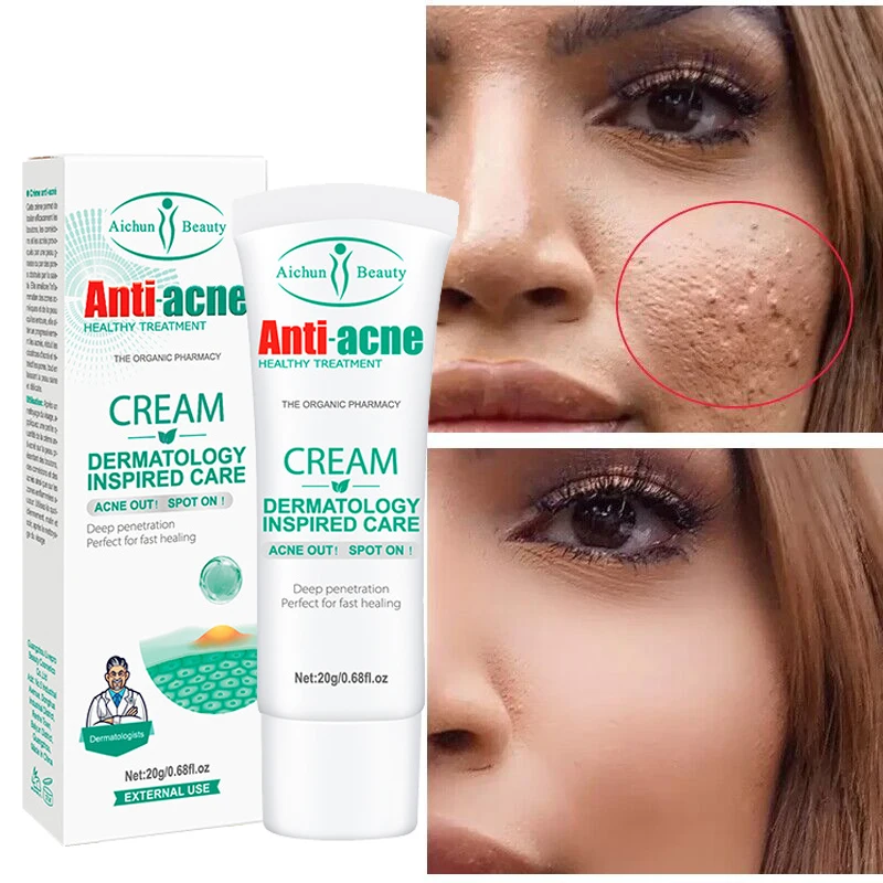 

Salicylic Acid Acne Treatment Face Cream Anti-Acne Herbal Pimple Scar Removal Gel Shrink Pore Oil Control Moisturizing Skin Care