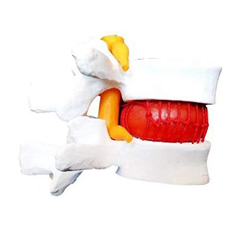 

Anatomical Human Lumbar Vertebrae Degenerative Lumbar Human Spine Model 1PCS