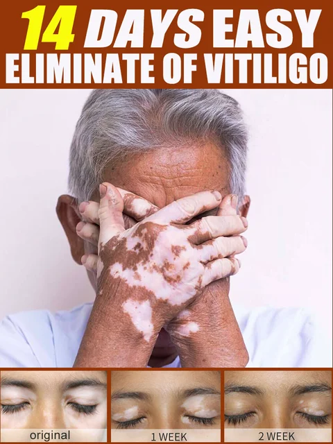 Vitiligo treatment cream  Vitiligo relief spray  Skin treatment lamp White Spot Removal vitiligo ointment Eliminate Vitiligo 1