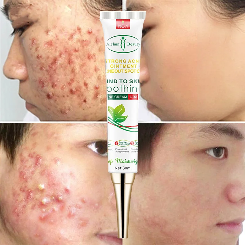 Effective Acne Removal Face Cream Herbal Acne Treatment Fade Dark Spots Whitening Gel Oil Control Moisturizing Repair Skin Care