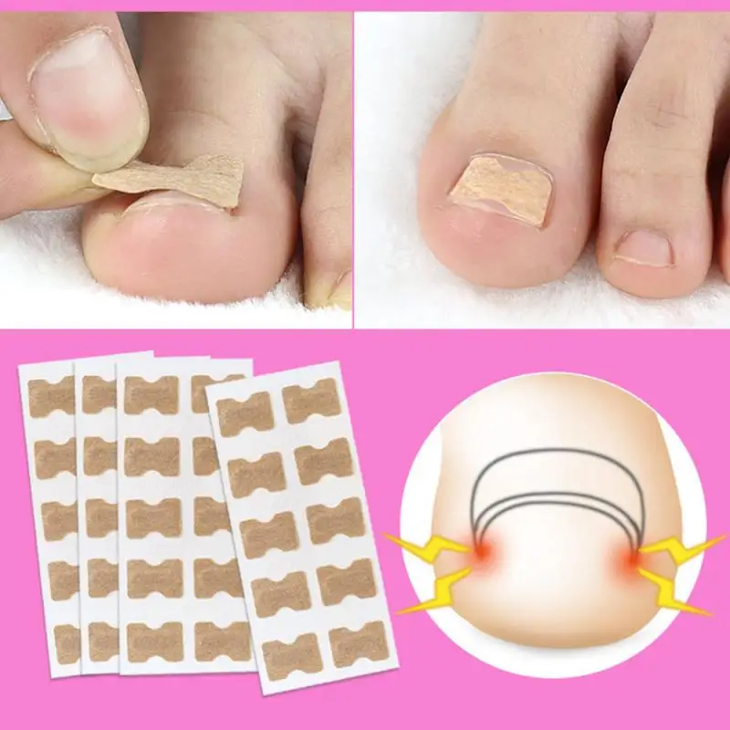 

5/10/20PCS Ingrown Toenail Correction Stickers Glue Free Ingrown Patch Finger Incorporated Orthodontic Toe Thumb Patch Sticker