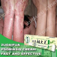 10pcs zudaifu psoriasis cream skin care herbal effective anti itch relief dermatitis eczematoid eczema ointment treatment 15pcs