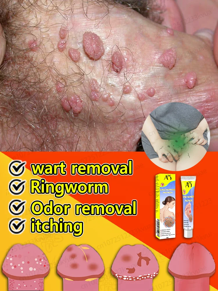 Крем для удаления бородавок ВПЧ Генитальные бородавки Подошвенные