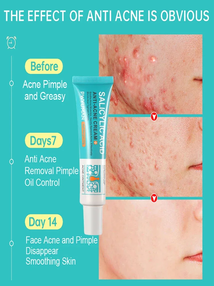 Салициловая кислота крем для лечения прыщей гель восстановления против