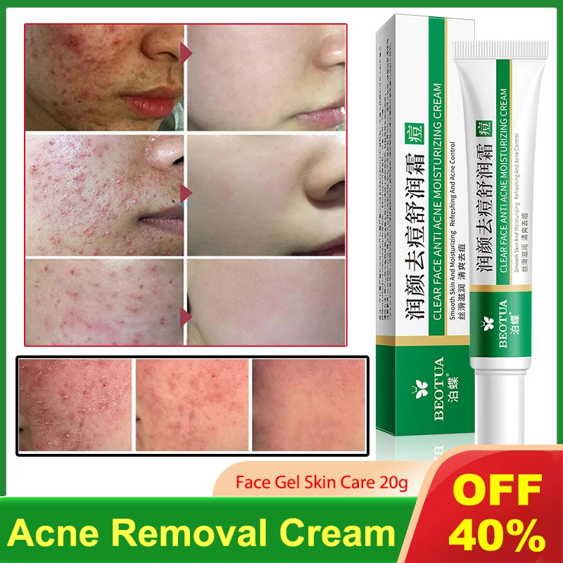 

20g Acne Treatment Cream Acne Scar Spots Removal Gel Anti-Acne Oil Control Shrink Pores Whitening Moisturizing Smooth Skin Care