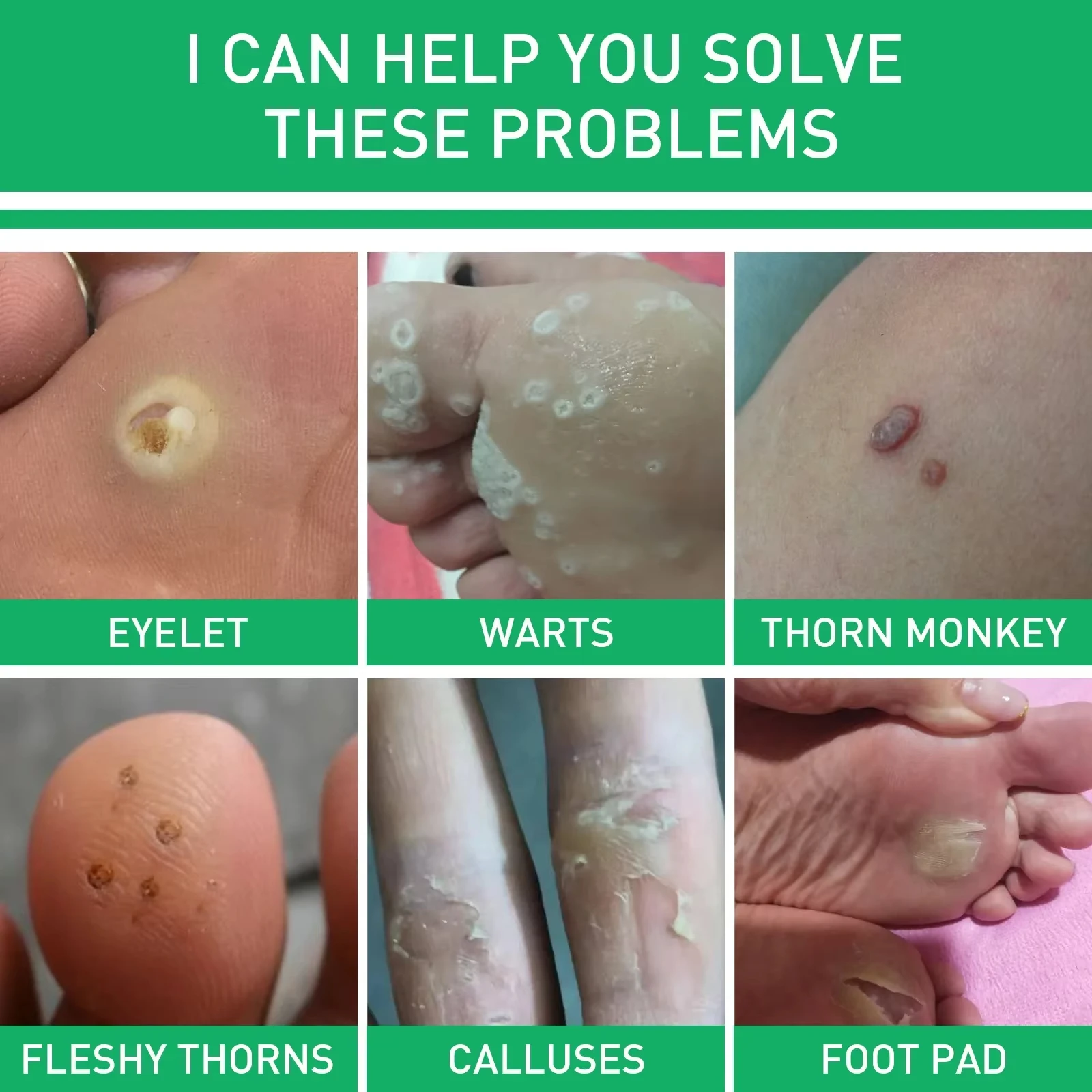 10ml Foot Corn Remover Chicken Eye Skin Infection Treatment Solution Dead Scab Removal Tool Health발톱무좀