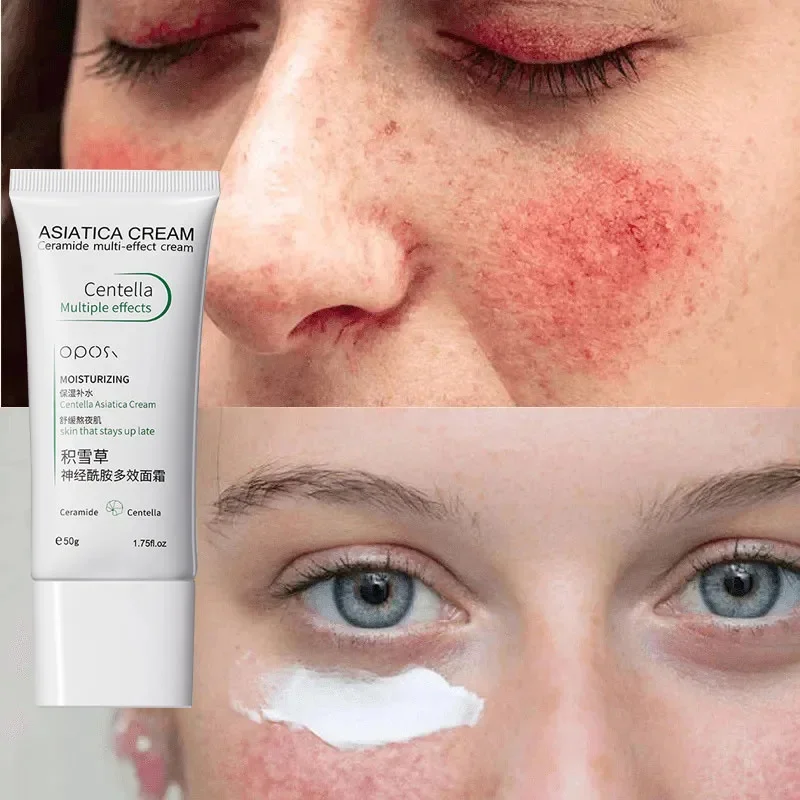 Крем для покраснения кожи лица быстрое восстановление сужение зуда