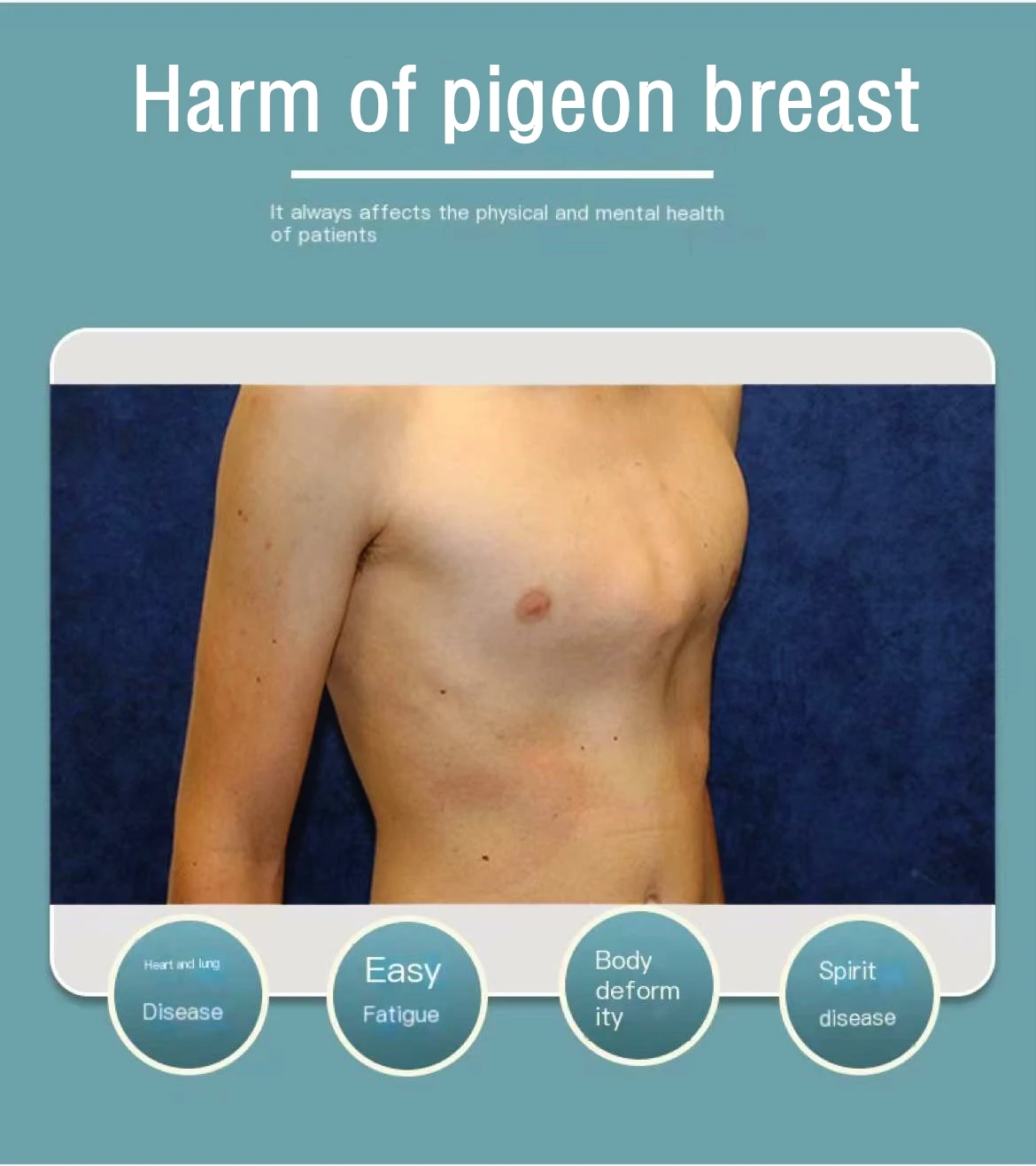 Медицинский корректор груди голубей Профессиональная регулируемая поддержка