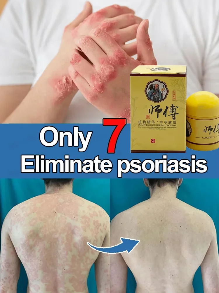 Privates Антибактериальный крем Мошонка Экзема Щедрый Кририс Грибковое инфекция