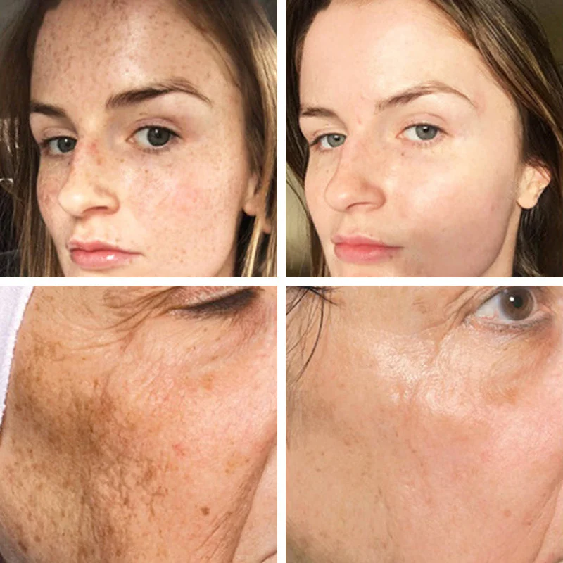 Отбеливающая Сыворотка для лица Dark средство удаления пятен коррекция веснушек