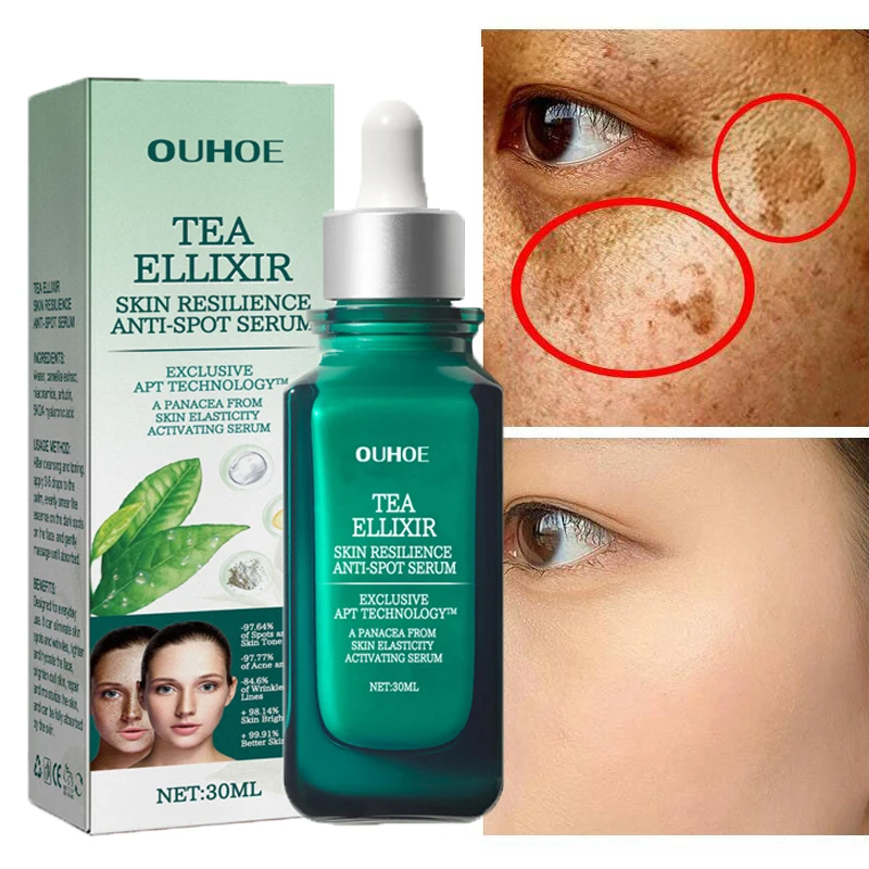 

Никотинамид для удаления веснушек, сыворотка против пятен и осветления, удаление темных пятен, пигмент меланин, коррекция красоты, уход за кожей