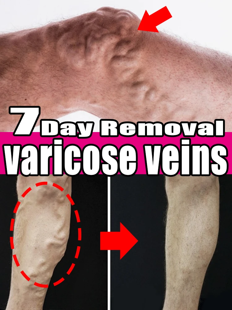 Эффективное лазерное устройство для васкулирования продукты пауков и ног