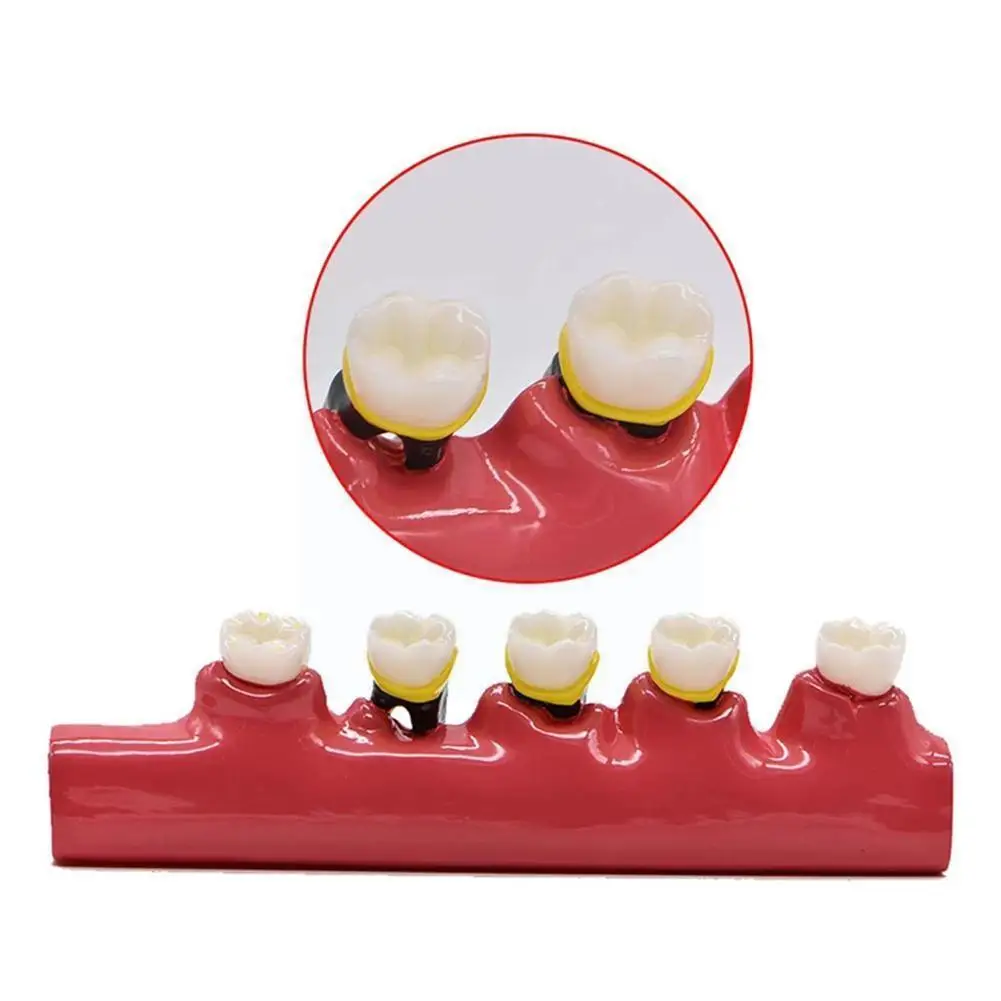 

Periodontal Disease Dental Teeth Model Display Periodontitis Communication Show Teaching Tooth Dentist Model U4r1
