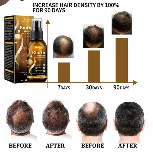 Hair Growth Products Biotin Fast Growing Hair Care Essential Oils Anti Hair Loss Spray Scalp Treatment For Men Women Hair Growth 1