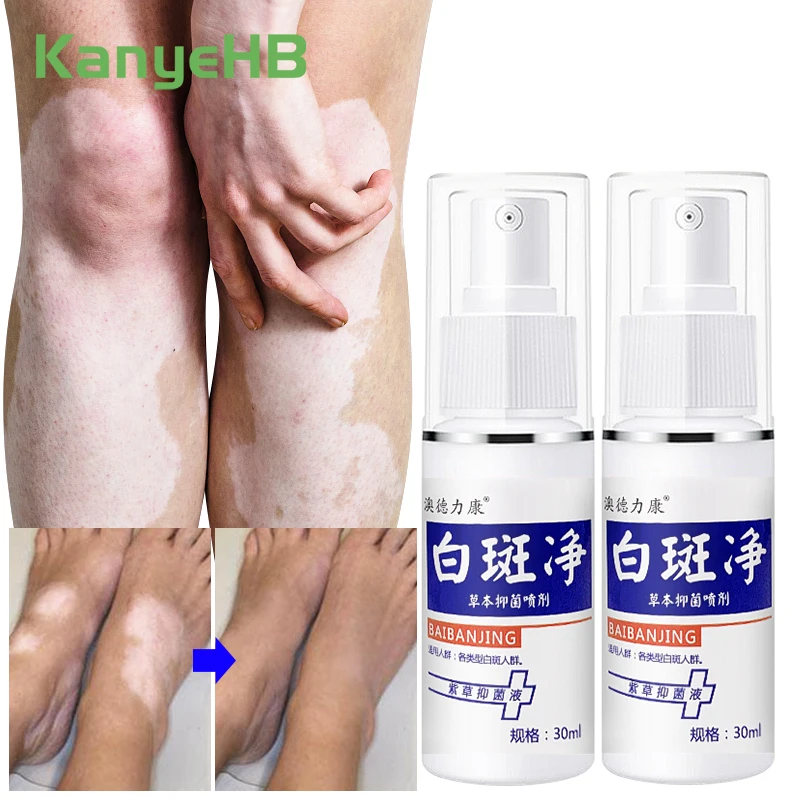 

2 шт., медицинский спрей для лечения лейкоплатии и белых пятен