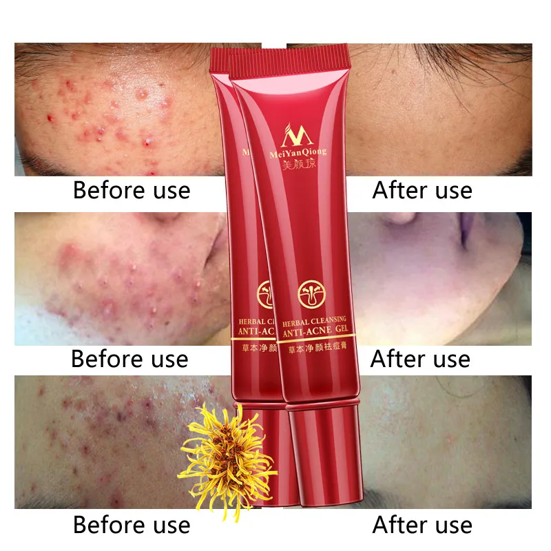 

Herbal Cleansing Acne Scar Cream Anti-Acne Treatment Pimples Blains Removal Cream Effectively Control Oil Fade Acne Dark Spots