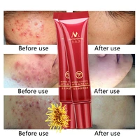 herbal cleansing acne scar cream anti acne treatment pimples blains removal cream effectively control oil fade acne dark spots