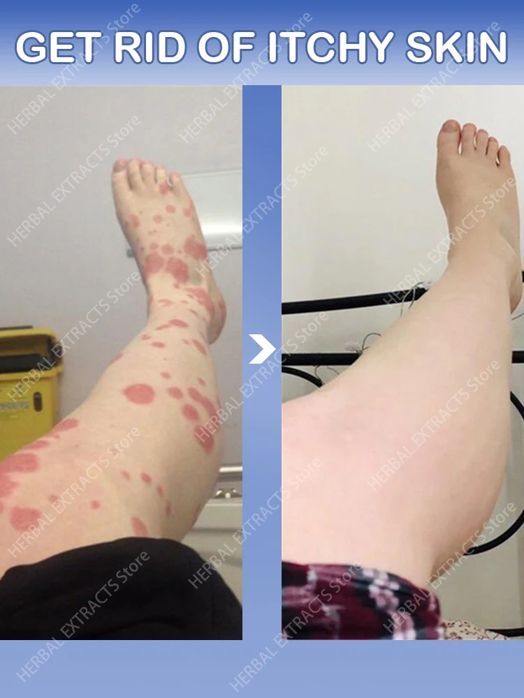 

Ointment from psoriasis cream for skin treatment