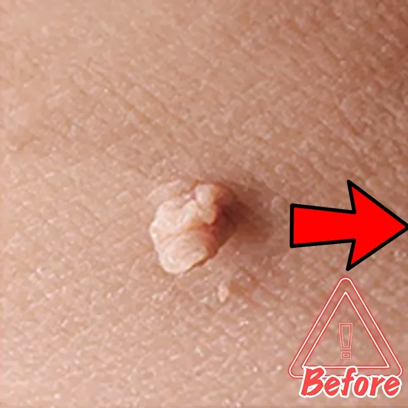 Морской невус на голове бородавки кожу головы обезьяне каулифтовая ручка