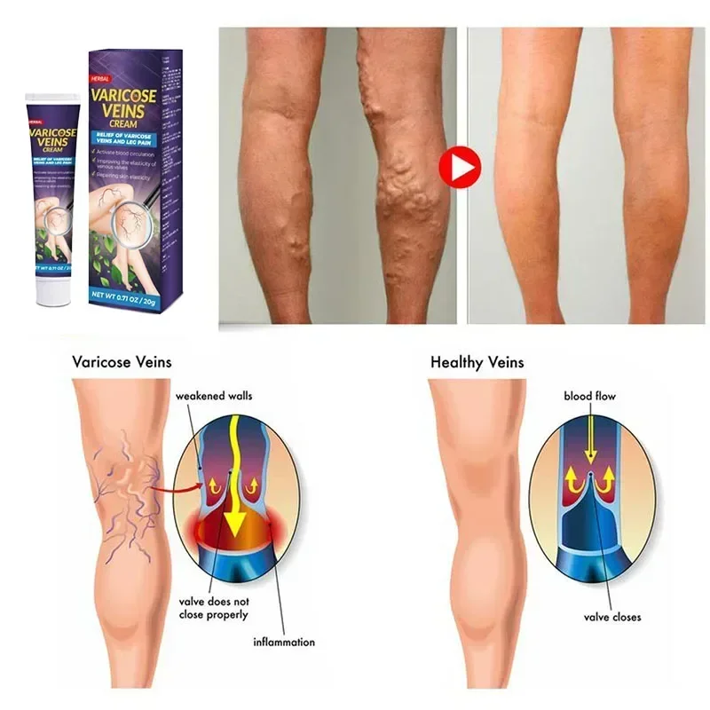 Лечение Варикозного расширения вен облегчение боли в ногах васкулит флебит паук