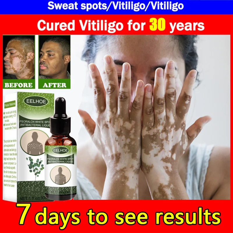 

Herbal Extract Vitiligo Serum Remove Ringworm White Spot Leukoplakia Disease Vitiligo Effective Treatment Cream Body Facial Care