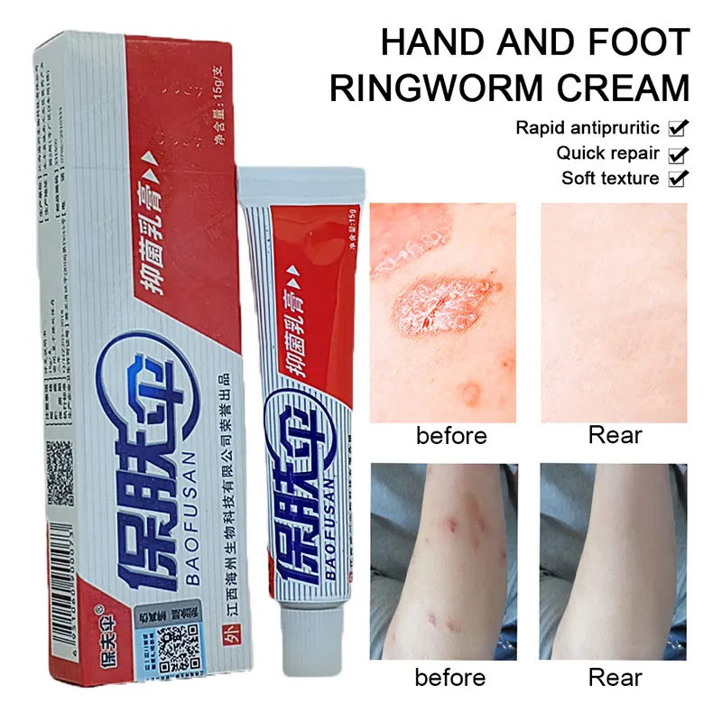 

15g Body care Skin Psoriasis Cream Dermatitis Eczematoid Eczema Ointment Treatment Natural Psoriasis scaly plaque psoriasi cream