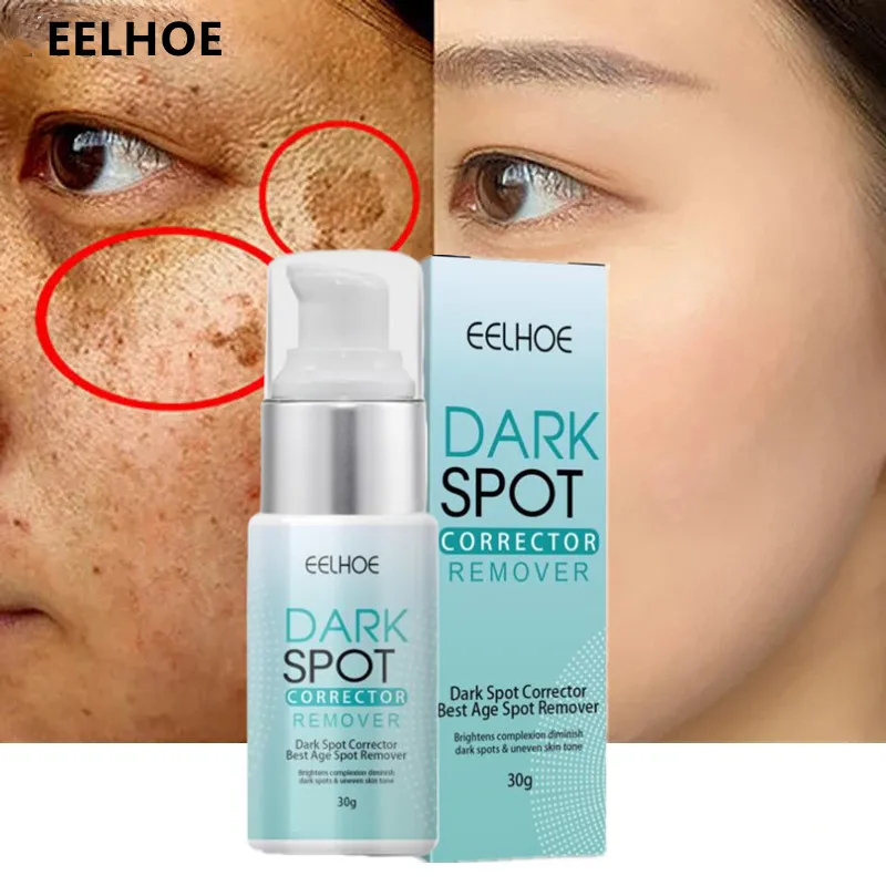 

Whitening Freckles Cream Remove Melasma Dark Spots Lighten Melanin Remover Moisturizing Brightening Face Skin Care 30ml