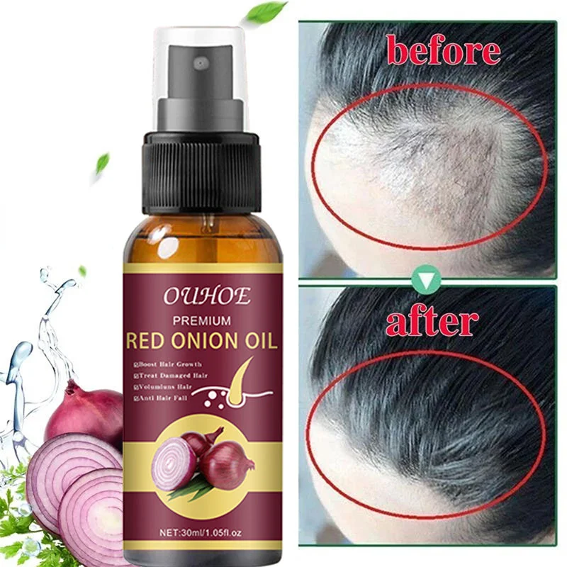 

30ml Red Onion Hair Growth Products for Men Women Fast Growing Hair Spray Essential Oil Improve Alopecia Hair Loss Treatment