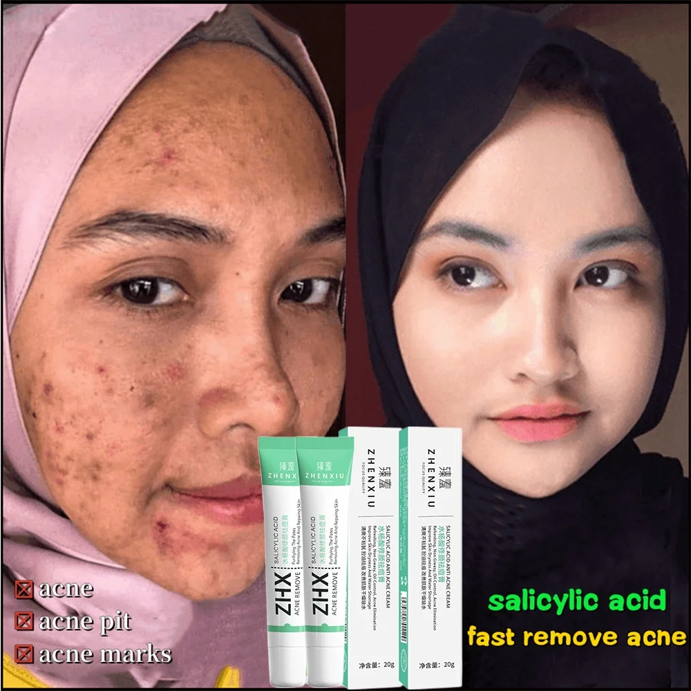 

100% Effective Remove Pimples Quickly Acne Cream Fades Acne Marks Repairs Pits Facial Scar Treatment Shrink Pores Gel Skin Care