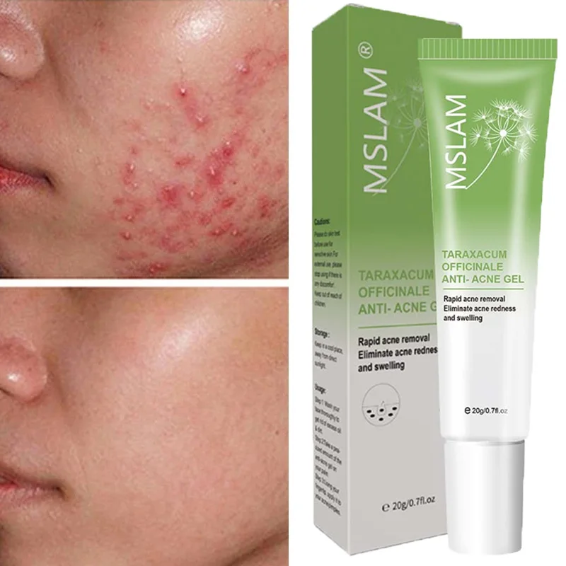 Acne Cream Treatment Herbal Pimple Gel Fade Acne Spots Oil Control Improve Roughness Shrink Pores Repair Redness Skin Care 20g