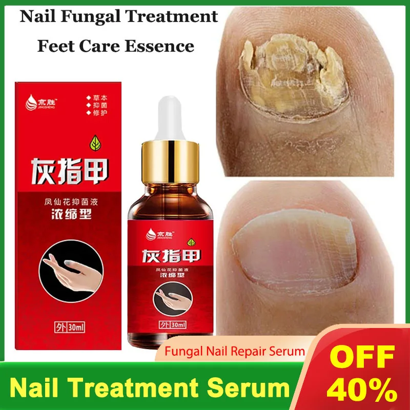 

Nail Fungal Treatment Feet Care Essence Nail Foot Whitening Toe Nail Fungus Removal Gel Anti Infection Paronychia Onychomycosis
