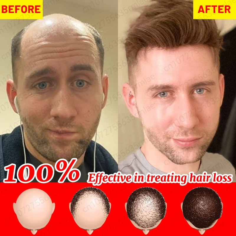 

Fast hair growth promoter products Hair loss Hereditary Seborrheic alopecia treatment oil For Hair growth essence Natural safety