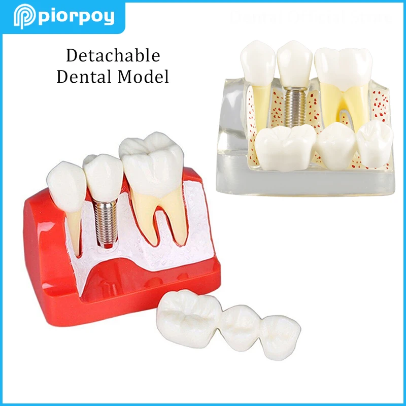 

Detachable Dental 4 Times Implant Tooth Model Removable Analysis Crown Bridge Demonstration Mold For Dentistry Studying Teaching