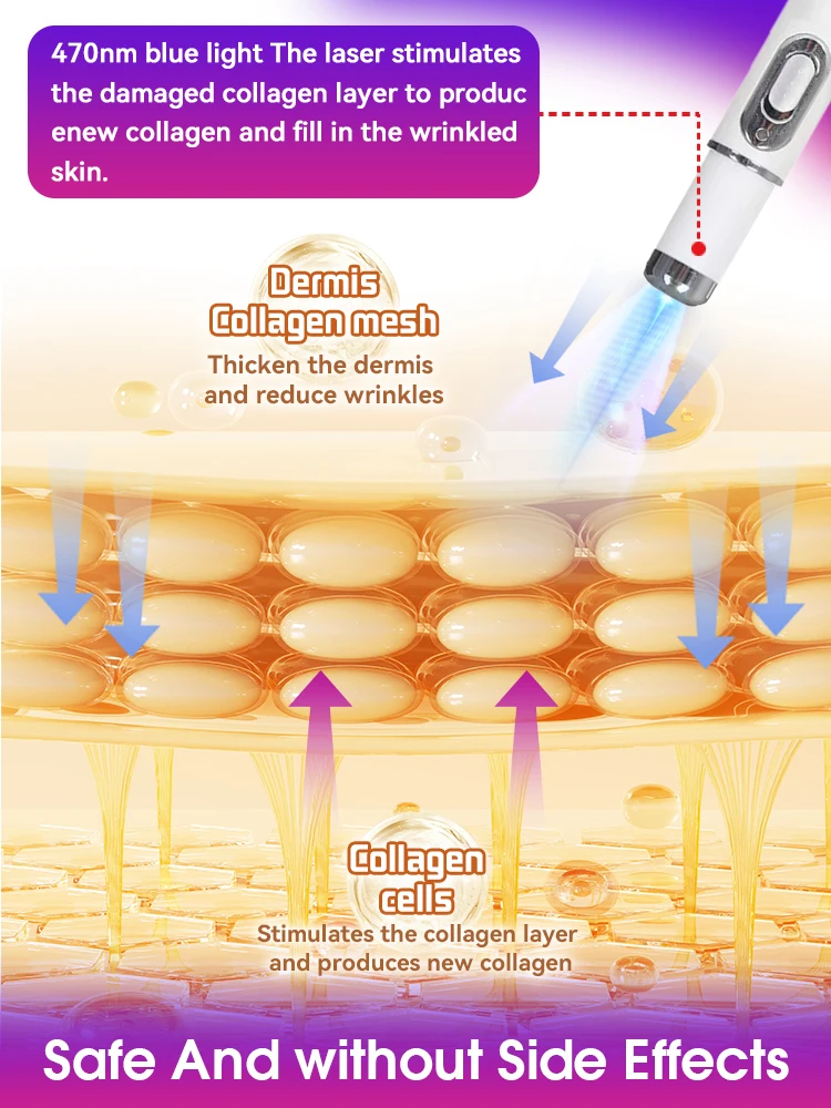 Лазерная ручка против морщин — обратите время и просмотр 20-летний младший!
