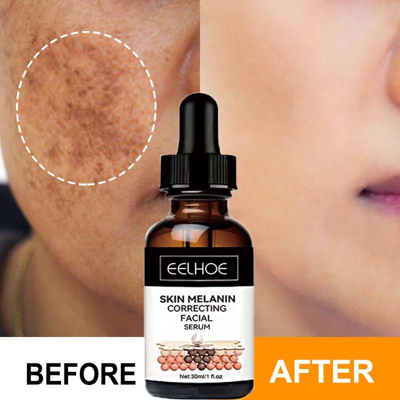 

Whitening Freckle Removal Serum Fade Dark Spots Melanin Pigmentation Anti Acne Nicotinamide Brightening Face Skin Care Cosmetics