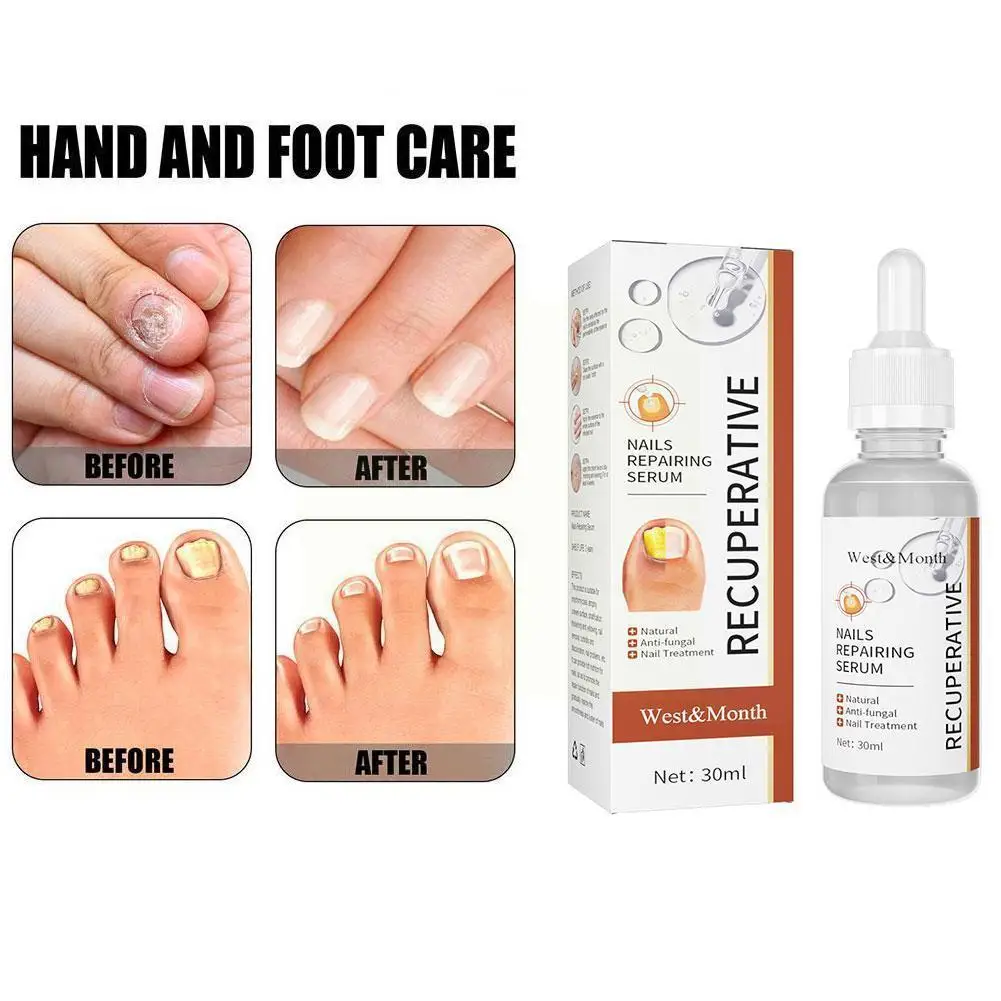 

Жидкость для восстановления ногтей, 30 мл, коррекция грибка ногтей, эссенция для рук, Уход за ногтями, ногти для ног, яркая нога I0n9