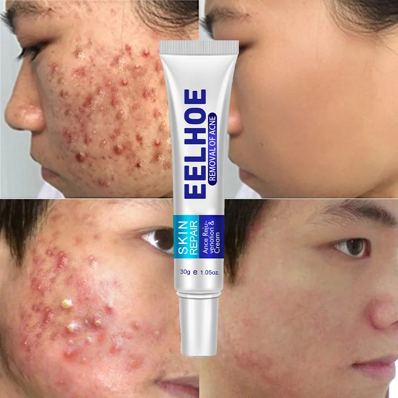 

Effective Acne Removal Cream Treatment Acne Dark Spot Scars Gel Shrink Pores Oil Control Moisturizing Face Skin Care Products