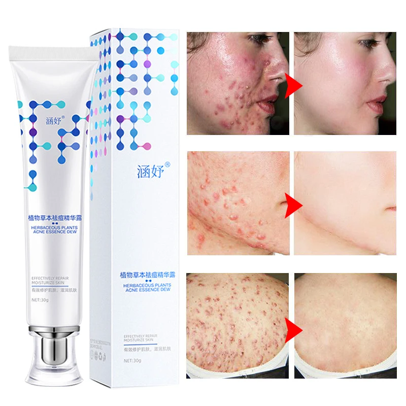 Effective Acne Removal Cream Herbal Oil Control Anti-Acne Gel Treatment Acne Mark  Remove Pimples Dark Spot Whitening Face Care